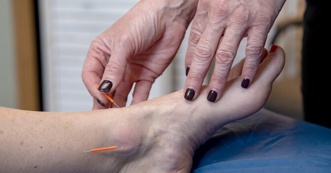 Acupuncture